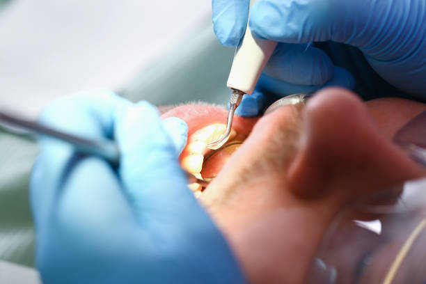 Best Emergency Tooth Extraction in Scaggsville, MD